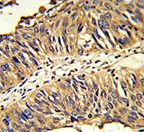 IHC testing of FFPE human lung carcinoma tissue with PDIA3 antibody. HIER: steam section in pH6 citrate buffer for 20 min and allow to cool prior to staining.