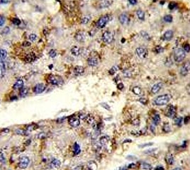 IHC testing of FFPE human hepatocellular carcinoma tissue with HNRPL antibody. HIER: steam section in pH6 citrate buffer for 20 min and allow to cool prior to staining.