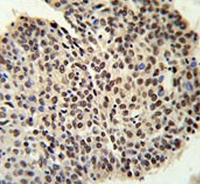 IHC testing of FFPE human lung carcinoma tissue with PRP19 antibody. HIER: steam section in pH6 citrate buffer for 20 min and allow to cool prior to staining.