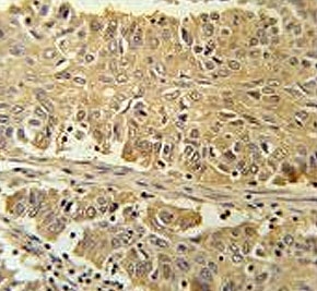 IHC testing of FFPE human lung carcinoma tissue with PGD antibody. HIER: steam section in pH6 citrate buffer for 20 min and allow to cool prior to staining.