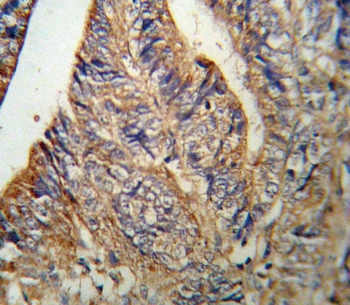 IHC testing of FFPE human colon carcinoma tissue with IL1RN antibody. HIER: steam section in pH6 citrate buffer for 20 min and allow to cool prior to staining.
