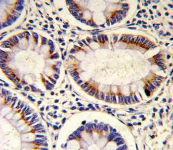 IHC testing of FFPE human colon carcinoma tissue with SORBS2 antibody. HIER: steam section in pH6 citrate buffer for 20 min and allow to cool prior to staining.