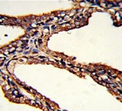 IHC testing of FFPE human prostate carcinoma tissue with PSMB9 antibody. HIER: steam section in pH6 citrate buffer for 20 min and allow to cool prior to staining.