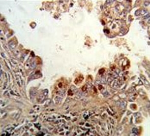 IHC testing of FFPE human lung carcinoma tissue with PKC alpha antibody. HIER: steam section in pH6 citrate buffer for 20 min and allow to cool prior to staining.