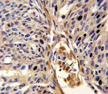 IHC testing of FFPE human lung carcinoma tissue with APEX2 antibody. HIER: steam section in pH6 citrate buffer for 20 min and allow to cool prior to staining.