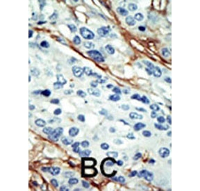 IHC staining of FFPE human breast cancer tissue with NUAK1 antibody. HIER: steam section in pH6 citrate buffer for 20 min and allow to cool prior to staining.
