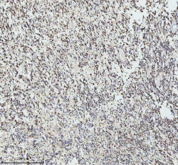 IHC analysis of GINS4 using anti-GINS4 antibody. GINS4 was detected in a paraffin-embedded section of human melanoma tissue. Heat mediated antigen retrieval was performed in EDTA buffer (pH 8.0, epitope retrieval solution). The tissue section was blocked with 10% goat serum. The tissue section was then incubated with 2 ug/ml rabbit anti-GINS4 antibody overnight at 4oC. Peroxidase Conjugated Goat Anti-rabbit IgG was used as secondary antibody and incubated for 30 minutes at 37oC. The tissue section was developed using an HRP secondary and DAB substrate.