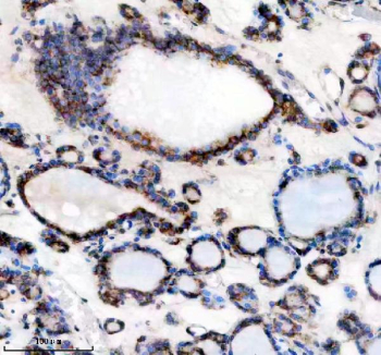 IHC analysis of TMED10 using anti-TMED10 antibody. TMED10 was detected in a paraffin-embedded section of human thyroid cancer tissue. Heat mediated antigen retrieval was performed in EDTA buffer (pH 8.0, epitope retrieval solution). The tissue section was blocked with 10% goat serum. The tissue section was then incubated with 2 ug/ml rabbit anti-TMED10 antibody overnight at 4oC. Peroxidase Conjugated Goat Anti-rabbit IgG was used as secondary antibody and incubated for 30 minutes at 37oC. The tissue section was developed using an HRP secondary and DAB substrate.