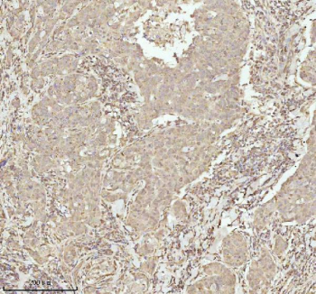 IHC analysis of NDUFA9 using anti-NDUFA9 antibody. NDUFA9 was detected in a paraffin-embedded section of human breast cancer tissue. Heat mediated antigen retrieval was performed in EDTA buffer (pH 8.0, epitope retrieval solution). The tissue section was blocked with 10% goat serum. The tissue section was then incubated with 2 ug/ml rabbit anti-NDUFA9 antibody overnight at 4oC. Peroxidase Conjugated Goat Anti-rabbit IgG was used as secondary antibody and incubated for 30 minutes at 37oC. The tissue section was developed using an HRP secondary and DAB substrate.