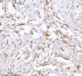 IHC analysis of STC2 using anti-STC2 antibody. STC2 was detected in a paraffin-embedded section of human breast cancer tissue. Heat mediated antigen retrieval was performed in EDTA buffer (pH 8.0, epitope retrieval solution). The tissue section was blocked with 10% goat serum. The tissue section was then incubated with 2 ug/ml rabbit anti-STC2 antibody overnight at 4oC. Peroxidase Conjugated Goat Anti-rabbit IgG was used as secondary antibody and incubated for 30 minutes at 37oC. The tissue section was developed using an HRP secondary and DAB substrate.