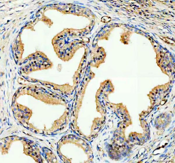 IHC analysis of NCOA2 using anti-NCOA2 antibody. NCOA2 was detected in a paraffin-embedded section of human prostate hyperplasia cancer tissue. Heat mediated antigen retrieval was performed in EDTA buffer (pH 8.0, epitope retrieval solution). The tissue section was blocked with 10% goat serum. The tissue section was then incubated with 2 ug/ml rabbit anti-NCOA2 antibody overnight at 4oC. Peroxidase Conjugated Goat Anti-rabbit IgG was used as secondary antibody and incubated for 30 minutes at 37oC. The tissue section was developed using an HRP secondary and DAB substrate.