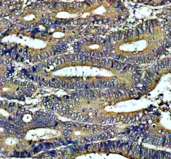 IHC analysis of PIWIL3 using anti-PIWIL3 antibody. PIWIL3 was detected in a paraffin-embedded section of human colon cancer tissue. Heat mediated antigen retrieval was performed in EDTA buffer (pH 8.0, epitope retrieval solution). The tissue section was blocked with 10% goat serum. The tissue section was then incubated with 2 ug/ml rabbit anti-PIWIL3 antibody overnight at 4oC. Peroxidase Conjugated Goat Anti-rabbit IgG was used as secondary antibody and incubated for 30 minutes at 37oC. The tissue section was developed using an HRP secondary and DAB substrate.