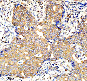 IHC analysis of AMPD1 using anti-AMPD1 antibody. AMPD1 was detected in a paraffin-embedded section of human breast cancer tissue. Heat mediated antigen retrieval was performed in EDTA buffer (pH 8.0, epitope retrieval solution). The tissue section was blocked with 10% goat serum. The tissue section was then incubated with 2 ug/ml rabbit anti-AMPD1 antibody overnight at 4oC. Peroxidase Conjugated Goat Anti-rabbit IgG was used as secondary antibody and incubated for 30 minutes at 37oC. The tissue section was developed using an HRP secondary and DAB substrate.