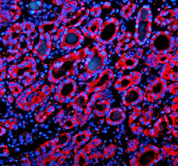 Immunofluorescent staining of SIL1 using anti-SIL1 antibody (red). SIL1 was detected in a paraffin-embedded section of human thyroid cancer tissue. Heat mediated antigen retrieval was performed in EDTA buffer (pH 8.0, epitope retrieval solution). The tissue section was blocked with 10% goat serum. The tissue section was then incubated with 5 ug/ml rabbit anti-SIL1 antibody overnight at 4oC. Cy3 Conjugated Goat Anti-Rabbit IgG was used as secondary antibody at 1:500 dilution and incubated for 30 minutes at 37oC. The section was counterstained with DAPI (blue). Visualize using a fluorescence microscope and filter sets appropriate for the label used.