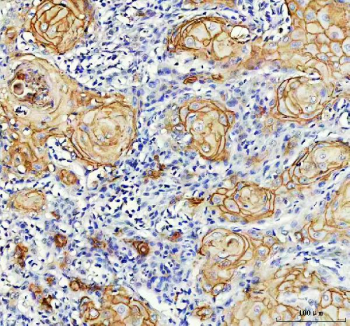 IHC analysis of LY6D using anti-LY6D antibody. LY6D was detected in a paraffin-embedded section of human skin cancer tissue. Heat mediated antigen retrieval was performed in EDTA buffer (pH 8.0, epitope retrieval solution). The tissue section was blocked with 10% goat serum. The tissue section was then incubated with 2 ug/ml rabbit anti-LY6D antibody overnight at 4oC. Peroxidase Conjugated Goat Anti-rabbit IgG was used as secondary antibody and incubated for 30 minutes at 37oC. The tissue section was developed using an HRP secondary and DAB substrate.