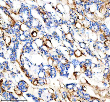 IHC analysis of FYCO1 using anti-FYCO1 antibody. FYCO1 was detected in a paraffin-embedded section of human thyroid cancer tissue. Heat mediated antigen retrieval was performed in EDTA buffer (pH 8.0, epitope retrieval solution). The tissue section was blocked with 10% goat serum. The tissue section was then incubated with 2 ug/ml rabbit anti-FYCO1 antibody overnight at 4oC. Peroxidase Conjugated Goat Anti-rabbit IgG was used as secondary antibody and incubated for 30 minutes at 37oC. The tissue section was developed using an HRP secondary and DAB substrate.