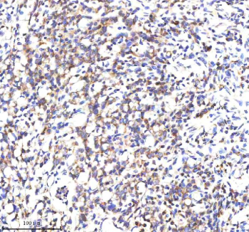 IHC analysis of SCNM1 using anti-SCNM1 antibody. SCNM1 was detected in a paraffin-embedded section of human stomach cancer tissue. Heat mediated antigen retrieval was performed in EDTA buffer (pH 8.0, epitope retrieval solution). The tissue section was blocked with 10% goat serum. The tissue section was then incubated with 2 ug/ml rabbit anti-SCNM1 antibody overnight at 4oC. Peroxidase Conjugated Goat Anti-rabbit IgG was used as secondary antibody and incubated for 30 minutes at 37oC. The tissue section was developed using an HRP secondary and DAB substrate.