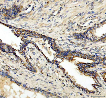 IHC analysis of CLCN3 using anti-CLCN3 antibody. CLCN3 was detected in a paraffin-embedded section of human prostatic cancer tissue. Heat mediated antigen retrieval was performed in EDTA buffer (pH 8.0, epitope retrieval solution). The tissue section was blocked with 10% goat serum. The tissue section was then incubated with 2 ug/ml rabbit anti-CLCN3 antibody overnight at 4oC. Peroxidase Conjugated Goat Anti-rabbit IgG was used as secondary antibody and incubated for 30 minutes at 37oC. The tissue section was developed using an HRP secondary and DAB substrate.