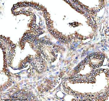 IHC analysis of PAM using anti-PAM antibody. PAM was detected in a paraffin-embedded section of human prostate cancer tissue. Heat mediated antigen retrieval was performed in EDTA buffer (pH 8.0, epitope retrieval solution). The tissue section was blocked with 10% goat serum. The tissue section was then incubated with 2 ug/ml rabbit anti-PAM antibody overnight at 4oC. Peroxidase Conjugated Goat Anti-rabbit IgG was used as secondary antibody and incubated for 30 minutes at 37oC. The tissue section was developed using an HRP secondary and DAB substrate.