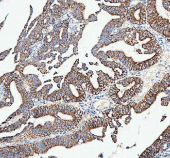 IHC analysis of CAMKK2 using anti-CAMKK2 antibody. CAMKK2 was detected in a paraffin-embedded section of human colorectal adenocarcinoma tissue. Heat mediated antigen retrieval was performed in EDTA buffer (pH 8.0, epitope retrieval solution). The tissue section was blocked with 10% goat serum. The tissue section was then incubated with 2 ug/ml rabbit anti-CAMKK2 antibody overnight at 4oC. Peroxidase Conjugated Goat Anti-rabbit IgG was used as secondary antibody and incubated for 30 minutes at 37oC. The tissue section was developed using an HRP secondary and DAB substrate.