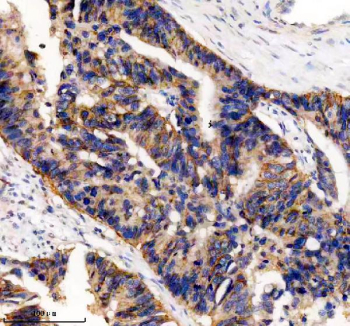 IHC analysis of UBE2A/UBE2B using anti-UBE2A/UBE2B antibody. UBE2A/UBE2B was detected in a paraffin-embedded section of human colon cancer tissue. Heat mediated antigen retrieval was performed in EDTA buffer (pH 8.0, epitope retrieval solution). The tissue section was blocked with 10% goat serum. The tissue section was then incubated with 2 ug/ml rabbit anti-UBE2A/UBE2B antibody overnight at 4oC. Peroxidase Conjugated Goat Anti-rabbit IgG was used as secondary antibody and incubated for 30 minutes at 37oC. The tissue section was developed using an HRP secondary and DAB substrate.