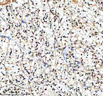 Immunohistochemical staining of PIF1 using anti-PIF1 antibody. PIF1 was detected in a paraffin-embedded section of human renal cancer tissue. Heat mediated antigen retrieval was performed in EDTA buffer (pH 8.0, epitope retrieval solution). The tissue section was blocked with 10% goat serum. The tissue section was then incubated with 2 ug/ml rabbit anti-PIF1 antibody overnight at 4oC. Peroxidase Conjugated Goat Anti-rabbit IgG was used as secondary antibody and incubated for 30 minutes at 37oC. The tissue section was developed using an HRP secondary and DAB substrate.