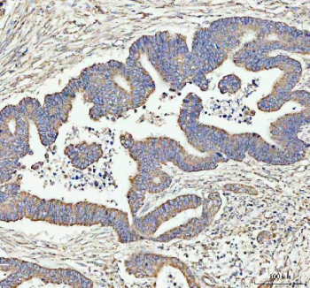 Immunohistochemical staining of ARHGEF12L using anti-ARHGEF12L antibody. ARHGEF12L was detected in a paraffin-embedded section of human colorectal adenocarcinoma tissue. Heat mediated antigen retrieval was performed in EDTA buffer (pH 8.0, epitope retrieval solution). The tissue section was blocked with 10% goat serum. The tissue section was then incubated with 2 ug/ml rabbit anti-ARHGEF12L antibody overnight at 4oC. Peroxidase Conjugated Goat Anti-rabbit IgG was used as secondary antibody and incubated for 30 minutes at 37oC. The tissue section was developed using an HRP secondary and DAB substrate.