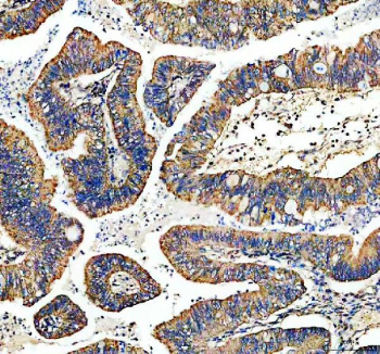 Immunohistochemical staining of TYRO3 using anti-TYRO3 antibody. TYRO3 was detected in a paraffin-embedded section of human colon cancer tissue. Heat mediated antigen retrieval was performed in EDTA buffer (pH 8.0, epitope retrieval solution). The tissue section was blocked with 10% goat serum. The tissue section was then incubated with 2 ug/ml rabbit anti-TYRO3 antibody overnight at 4oC. Peroxidase Conjugated Goat Anti-rabbit IgG was used as secondary antibody and incubated for 30 minutes at 37oC. The tissue section was developed using an HRP secondary and DAB substrate.