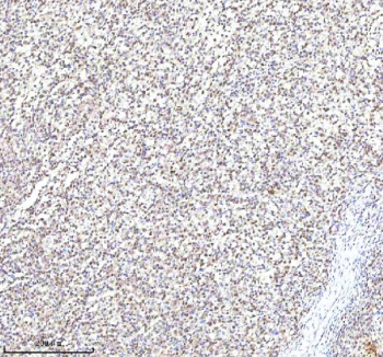 Immunohistochemical staining of RLIM using anti-RLIM antibody. RLIM was detected in a paraffin-embedded section of diffuse large B-cell lymphoma of human intestine tissue. Heat mediated antigen retrieval was performed in EDTA buffer (pH 8.0, epitope retrieval solution). The tissue section was blocked with 10% goat serum. The tissue section was then incubated with 2 ug/ml rabbit anti-RLIM antibody overnight at 4oC. Peroxidase Conjugated Goat Anti-rabbit IgG was used as secondary antibody and incubated for 30 minutes at 37oC. The tissue section was developed using an HRP secondary and DAB substrate.