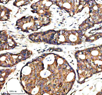 Immunohistochemical staining of SYAP1 using anti-SYAP1 antibody. SYAP1 was detected in a paraffin-embedded section of human breast cancer tissue. Heat mediated antigen retrieval was performed in EDTA buffer (pH 8.0, epitope retrieval solution). The tissue section was blocked with 10% goat serum. The tissue section was then incubated with 2 ug/ml rabbit anti-SYAP1 antibody overnight at 4oC. Peroxidase Conjugated Goat Anti-rabbit IgG was used as secondary antibody and incubated for 30 minutes at 37oC. The tissue section was developed using an HRP secondary and DAB substrate.