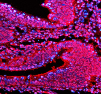 Immunofluorescent staining of PSMD1 using anti-PSMD1 antibody. PSMD1 was detected in a paraffin-embedded section of human colon cancer tissue. Heat mediated antigen retrieval was performed in EDTA buffer (pH 8.0, epitope retrieval solution). The tissue section was blocked with 10% goat serum. The tissue section was then incubated with 5 ug/ml rabbit anti-PSMD1 antibody overnight at 4oC. Cy3 Conjugated Goat Anti-Rabbit IgG was used as secondary antibody at 1:500 dilution and incubated for 30 minutes at 37oC. The section was counterstained with DAPI nuclear stain (blue). Visualize using a fluorescence microscope and filter sets appropriate for the label used.