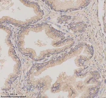 Immunohistochemical staining of TMEM175 using anti-TMEM175 antibody. TMEM175 was detected in a paraffin-embedded section of human prostate cancer tissue. Heat mediated antigen retrieval was performed in EDTA buffer (pH 8.0, epitope retrieval solution). The tissue section was blocked with 10% goat serum. The tissue section was then incubated with 2 ug/ml rabbit anti-TMEM175 antibody overnight at 4oC. Peroxidase Conjugated Goat Anti-rabbit IgG was used as secondary antibody and incubated for 30 minutes at 37oC. The tissue section was developed using an HRP secondary and DAB substrate.