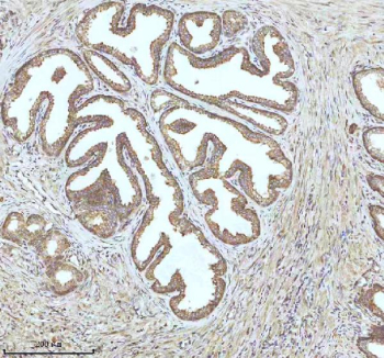 Immunohistochemical staining of IGFL3 using anti-IGFL3 antibody. IGFL3 was detected in a paraffin-embedded section of human prostate cancer tissue. Heat mediated antigen retrieval was performed in EDTA buffer (pH 8.0, epitope retrieval solution). The tissue section was blocked with 10% goat serum. The tissue section was then incubated with 2 ug/ml rabbit anti-IGFL3 antibody overnight at 4oC. Peroxidase Conjugated Goat Anti-rabbit IgG was used as secondary antibody and incubated for 30 minutes at 37oC. The tissue section was developed using an HRP secondary and DAB substrate.