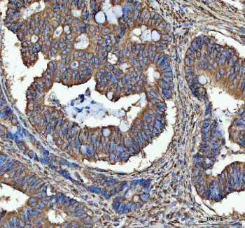 Immunohistochemical staining of SEC61G using anti-SEC61G antibody. SEC61G was detected in a paraffin-embedded section of human colorectal adenocarcinoma tissue. Heat mediated antigen retrieval was performed in EDTA buffer (pH 8.0, epitope retrieval solution). The tissue section was blocked with 10% goat serum. The tissue section was then incubated with 2 ug/ml rabbit anti-SEC61G antibody overnight at 4oC. Peroxidase Conjugated Goat Anti-rabbit IgG was used as secondary antibody and incubated for 30 minutes at 37oC. The tissue section was developed using an HRP secondary and DAB substrate.