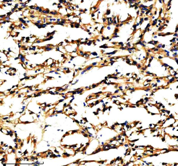 Immunohistochemical staining of PXDN using anti-PXDN antibody. PXDN was detected in a paraffin-embedded section of human renal cancer tissue. Heat mediated antigen retrieval was performed in EDTA buffer (pH 8.0, epitope retrieval solution). The tissue section was blocked with 10% goat serum. The tissue section was then incubated with 2 ug/ml rabbit anti-PXDN antibody overnight at 4oC. Peroxidase Conjugated Goat Anti-rabbit IgG was used as secondary antibody and incubated for 30 minutes at 37oC. The tissue section was developed using an HRP secondary and DAB substrate.