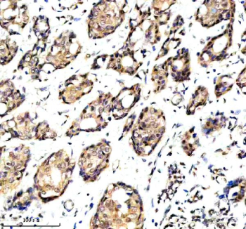 Immunohistochemical staining of OARD1 using anti-OARD1 antibody. OARD1 was detected in a paraffin-embedded section of human breast cancer tissue. Heat mediated antigen retrieval was performed in EDTA buffer (pH 8.0, epitope retrieval solution). The tissue section was blocked with 10% goat serum. The tissue section was then incubated with 2 ug/ml rabbit anti-OARD1 antibody overnight at 4oC. Peroxidase Conjugated Goat Anti-rabbit IgG was used as secondary antibody and incubated for 30 minutes at 37oC. The tissue section was developed using an HRP secondary and DAB substrate.