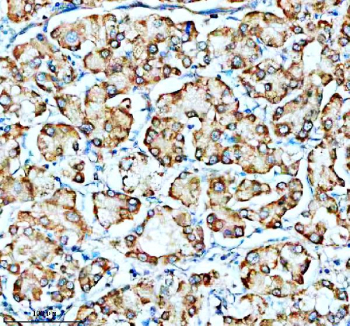 Immunohistochemical staining of SMG8 using anti-SMG8 antibody. SMG8 was detected in a paraffin-embedded section of human liver cancer tissue. Heat mediated antigen retrieval was performed in EDTA buffer (pH 8.0, epitope retrieval solution). The tissue section was blocked with 10% goat serum. The tissue section was then incubated with 2 ug/ml rabbit anti-SMG8 antibody overnight at 4oC. Peroxidase Conjugated Goat Anti-rabbit IgG was used as secondary antibody and incubated for 30 minutes at 37oC. The tissue section was developed using an HRP secondary and DAB substrate.