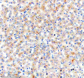 Immunohistochemical staining of NSUN6 using anti-NSUN6 antibody. NSUN6 was detected in a paraffin-embedded section of human liver cancer tissue. Heat mediated antigen retrieval was performed in EDTA buffer (pH 8.0, epitope retrieval solution). The tissue section was blocked with 10% goat serum. The tissue section was then incubated with 2 ug/ml rabbit anti-NSUN6 antibody overnight at 4oC. Peroxidase Conjugated Goat Anti-rabbit IgG was used as secondary antibody and incubated for 30 minutes at 37oC. The tissue section was developed using an HRP secondary and DAB substrate.