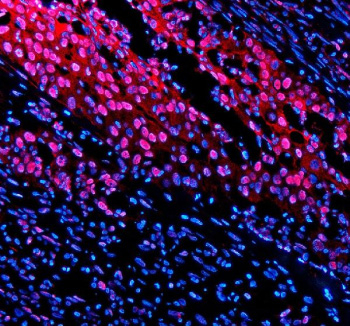 Immunofluorescent staining of TNFAIP2 using anti-TNFAIP2 antibody (red). TNFAIP2 was detected in a paraffin-embedded section of human bladder cancer tissue. Heat mediated antigen retrieval was performed in EDTA buffer (pH 8.0, epitope retrieval solution). The tissue section was blocked with 10% goat serum. The tissue section was then incubated with 5 ug/ml rabbit anti-TNFAIP2 antibody overnight at 4oC. Cy3 Conjugated Goat Anti-Rabbit IgG was used as secondary antibody at 1:500 dilution and incubated for 30 minutes at 37oC. The section was counterstained with DAPI nuclear stain (blue). Visualize using a fluorescence microscope and filter sets appropriate for the label used.