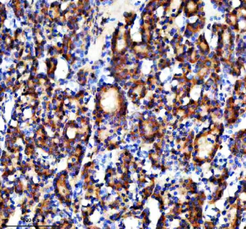 Immunohistochemical staining of NAGK using anti-NAGK antibody. NAGK was detected in a paraffin-embedded section of human thyroid cancer tissue. Heat mediated antigen retrieval was performed in EDTA buffer (pH 8.0, epitope retrieval solution). The tissue section was blocked with 10% goat serum. The tissue section was then incubated with 2 ug/ml rabbit anti-NAGK antibody overnight at 4oC. Peroxidase Conjugated Goat Anti-rabbit IgG was used as secondary antibody and incubated for 30 minutes at 37oC. The tissue section was developed using an HRP secondary and DAB substrate.