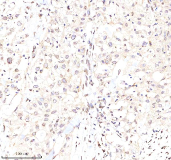 Immunohistochemical staining of Lamin B2 using anti-Lamin B2 antibody. Lamin B2 was detected in a paraffin-embedded section of human bladder cancer tissue. Heat mediated antigen retrieval was performed in EDTA buffer (pH 8.0, epitope retrieval solution). The tissue section was blocked with 10% goat serum. The tissue section was then incubated with 2 ug/ml rabbit anti-Lamin B2 antibody overnight at 4oC. Peroxidase Conjugated Goat Anti-rabbit IgG was used as secondary antibody and incubated for 30 minutes at 37oC. The tissue section was developed using an HRP secondary and DAB substrate.
