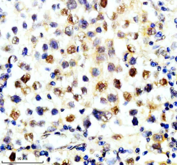 Immunohistochemical staining of SLX4 using anti-SLX4 antibody. SLX4 was detected in a paraffin-embedded section of human testis cancer tissue. Heat mediated antigen retrieval was performed in EDTA buffer (pH 8.0, epitope retrieval solution). The tissue section was blocked with 10% goat serum. The tissue section was then incubated with 2 ug/ml rabbit anti-SLX4 antibody overnight at 4oC. Peroxidase Conjugated Goat Anti-rabbit IgG was used as secondary antibody and incubated for 30 minutes at 37oC. The tissue section was developed using an HRP secondary and DAB substrate.