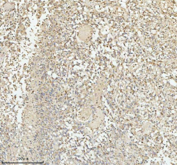 Immunohistochemical staining of PACSIN1 using anti-PACSIN1 antibody. PACSIN1 was detected in a paraffin-embedded section of human glioblastoma tissue. Heat mediated antigen retrieval was performed in EDTA buffer (pH 8.0, epitope retrieval solution). The tissue section was blocked with 10% goat serum. The tissue section was then incubated with 2 ug/ml rabbit anti-PACSIN1 antibody overnight at 4oC. Peroxidase Conjugated Goat Anti-rabbit IgG was used as secondary antibody and incubated for 30 minutes at 37oC. The tissue section was developed using an HRP secondary and DAB substrate.
