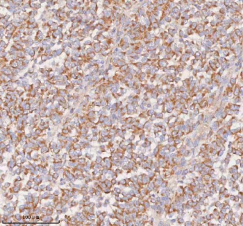 Immunohistochemical staining of SLC14A1 using anti-SLC14A1 antibody. SLC14A1 was detected in a paraffin-embedded section of human melanoma tissue. Heat mediated antigen retrieval was performed in EDTA buffer (pH 8.0, epitope retrieval solution). The tissue section was blocked with 10% goat serum. The tissue section was then incubated with 2 ug/ml rabbit anti-SLC14A1 antibody overnight at 4oC. Peroxidase Conjugated Goat Anti-rabbit IgG was used as secondary antibody and incubated for 30 minutes at 37oC. The tissue section was developed using an HRP secondary and DAB substrate.