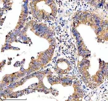 Immunohistochemical staining of HTR3E using anti-HTR3E antibody. HTR3E was detected in a paraffin-embedded section of human colon cancer tissue. Heat mediated antigen retrieval was performed in EDTA buffer (pH 8.0, epitope retrieval solution). The tissue section was blocked with 10% goat serum. The tissue section was then incubated with 2 ug/ml rabbit anti-HTR3E antibody overnight at 4oC. Peroxidase Conjugated Goat Anti-rabbit IgG was used as secondary antibody and incubated for 30 minutes at 37oC. The tissue section was developed using an HRP secondary and DAB substrate.