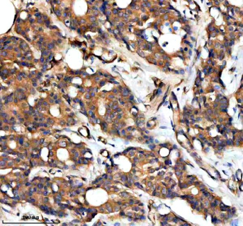 Immunohistochemical staining of RAPH1 using anti-RAPH1 antibody. RAPH1 was detected in a paraffin-embedded section of human breast cancer tissue. Heat mediated antigen retrieval was performed in EDTA buffer (pH 8.0, epitope retrieval solution). The tissue section was blocked with 10% goat serum. The tissue section was then incubated with 2 ug/ml rabbit anti-RAPH1 antibody overnight at 4oC. Peroxidase Conjugated Goat Anti-rabbit IgG was used as secondary antibody and incubated for 30 minutes at 37oC. The tissue section was developed using an HRP secondary and DAB substrate.