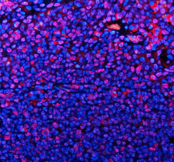 Immunofluorescent staining of TMC6 using anti-TMC6 antibody (red). TMC6 was detected in a paraffin-embedded section of human tonsil tissue. Heat mediated antigen retrieval was performed in EDTA buffer (pH 8.0, epitope retrieval solution). The tissue section was blocked with 10% goat serum. The tissue section was then incubated with 5 ug/ml rabbit anti-TMC6 antibody overnight at 4oC. Cy3 Conjugated Goat Anti-Rabbit IgG was used as secondary antibody at 1:500 dilution and incubated for 30 minutes at 37oC. The section was counterstained with DAPI nuclear stain (blue). Visualize using a fluorescence microscope and filter sets appropriate for the label used.
