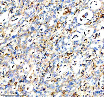 Immunohistochemical staining of DOCK8 using anti-DOCK8 antibody. DOCK8 was detected in a paraffin-embedded section of human pancreas cancer tissue. Heat mediated antigen retrieval was performed in EDTA buffer (pH 8.0, epitope retrieval solution). The tissue section was blocked with 10% goat serum. The tissue section was then incubated with 2 ug/ml rabbit anti-DOCK8 antibody overnight at 4oC. Peroxidase Conjugated Goat Anti-rabbit IgG was used as secondary antibody and incubated for 30 minutes at 37oC. The tissue section was developed using an HRP secondary and DAB substrate.