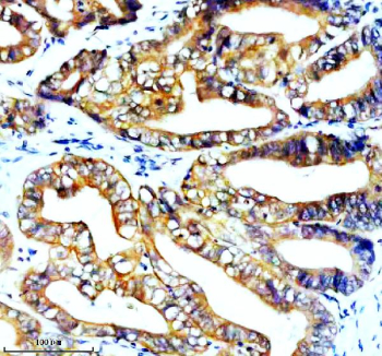 Immunohistochemical staining of STK33 using anti-STK33 antibody. STK33 was detected in a paraffin-embedded section of human colon cancer tissue. Heat mediated antigen retrieval was performed in EDTA buffer (pH 8.0, epitope retrieval solution). The tissue section was blocked with 10% goat serum. The tissue section was then incubated with 2 ug/ml rabbit anti-STK33 antibody overnight at 4oC. Peroxidase Conjugated Goat Anti-rabbit IgG was used as secondary antibody and incubated for 30 minutes at 37oC. The tissue section was developed using an HRP secondary and DAB substrate.