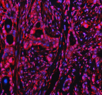 Immunofluorescent staining of PPP1R8 using anti-PPP1R8 antibody (red). PPP1R8 was detected in a paraffin-embedded section of human pancreatic cancer tissue. Heat mediated antigen retrieval was performed in EDTA buffer (pH 8.0, epitope retrieval solution). The tissue section was blocked with 10% goat serum. The tissue section was then incubated with 5 ug/ml rabbit anti-PPP1R8 antibody overnight at 4oC. Cy3 Conjugated Goat Anti-Rabbit IgG was used as secondary antibody at 1:500 dilution and incubated for 30 minutes at 37oC. The section was counterstained with DAPI nuclear stain (blue). Visualize using a fluorescence microscope and filter sets appropriate for the label used.